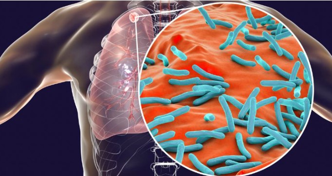 Día Mundial de la Tuberculosis: nuevas pautas para el abordaje a nivel nacional