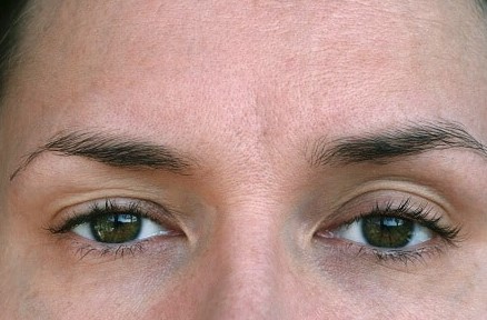 Párpados flácidos y ojeras: de qué manera actúa la blefaroplastia con láser&nbsp;híbrido