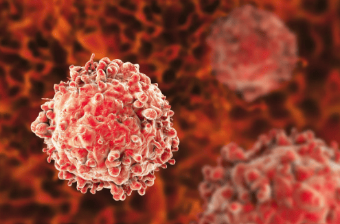 Leucemia linfocítica crónica: 9 de cada 10 no reconoce los síntomas